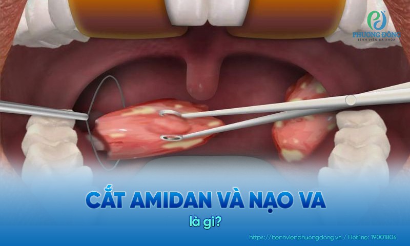 nạo amidan là gì - Image 3