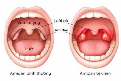 nạo amidan là gì - Image 4