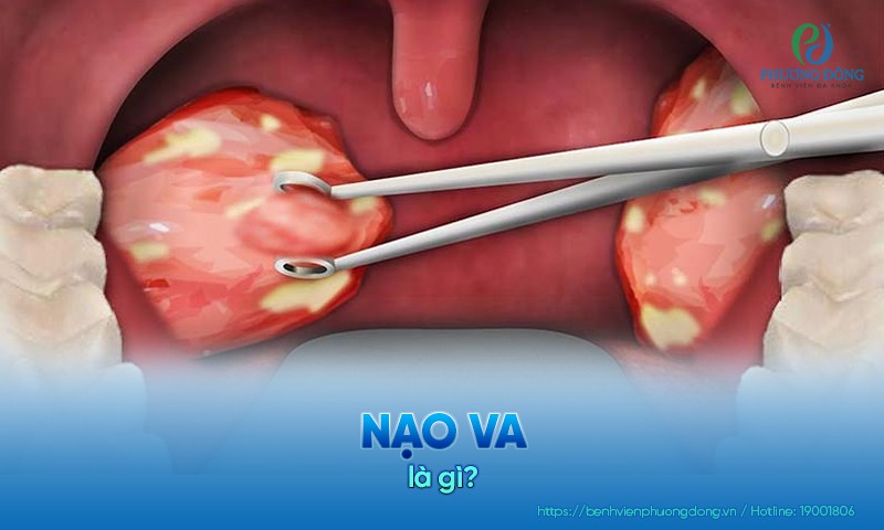 nạo amidan là gì - Image 5