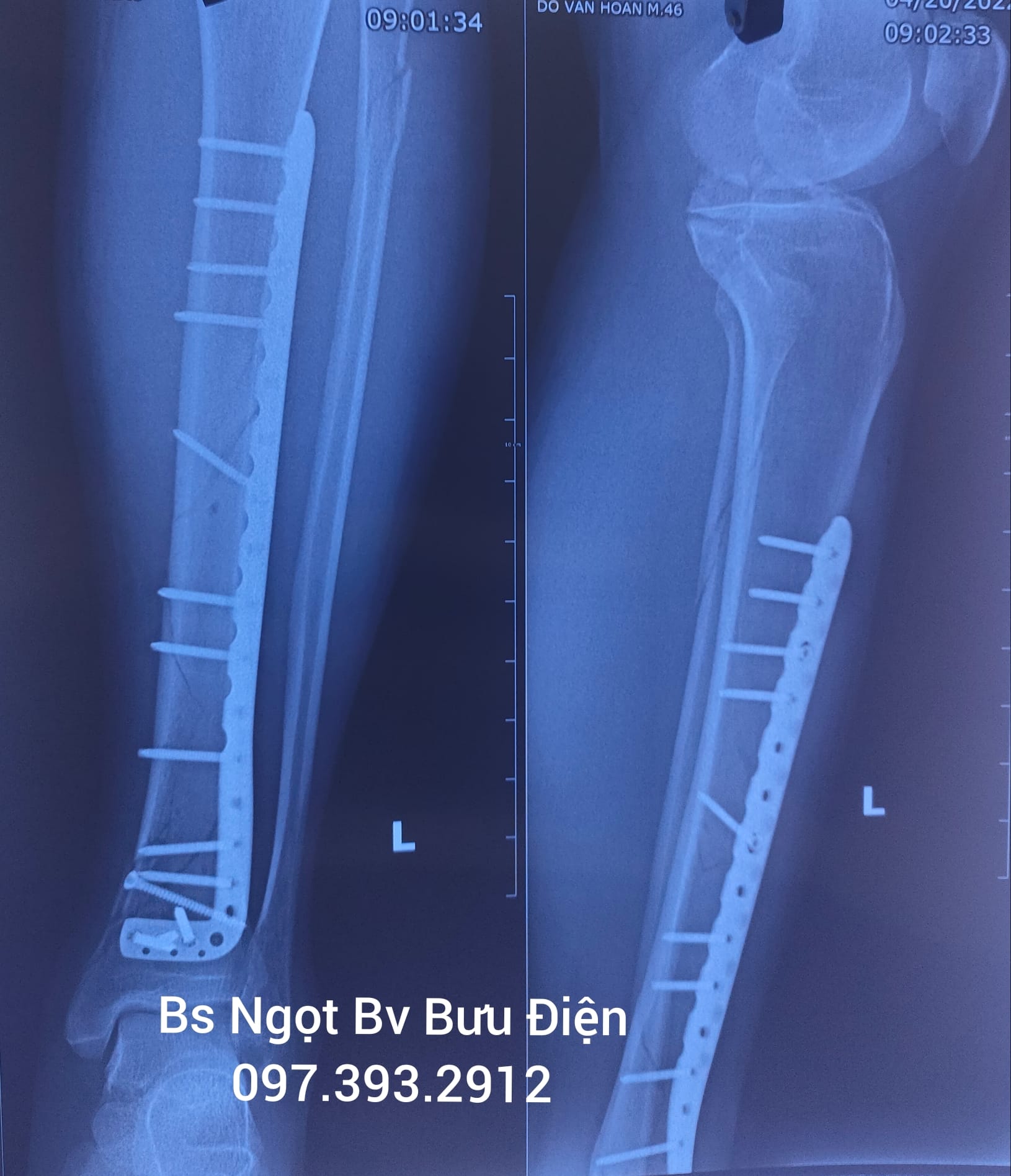 nẹp vít xương cẳng chân - Image 2