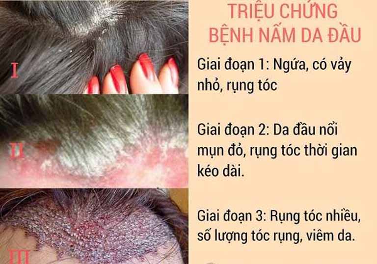 ngứa da đầu kéo dài - Image 5
