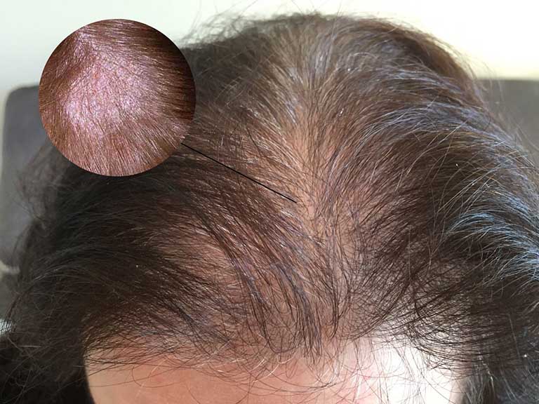 ngứa da đầu và rụng tóc - Image 4