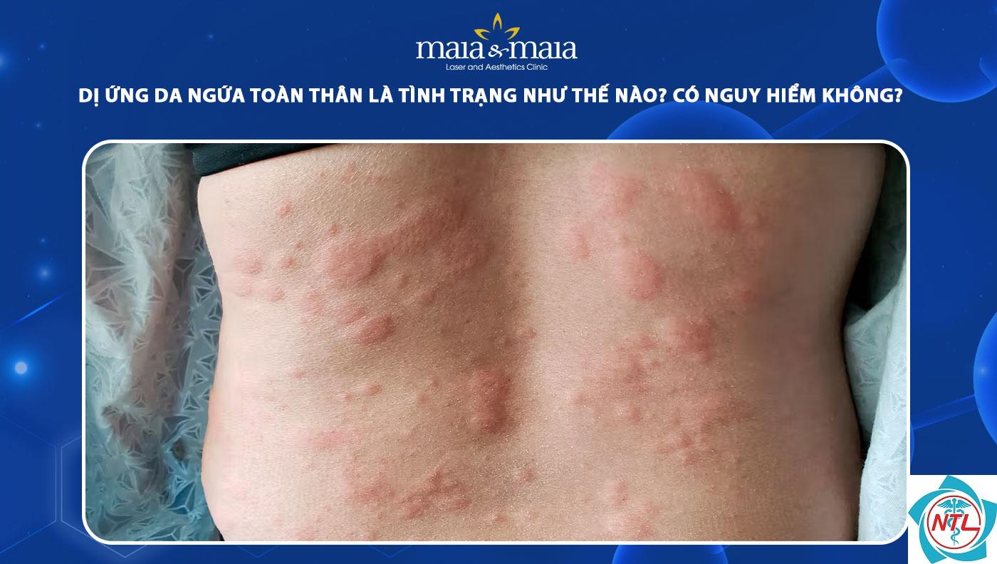 ngứa da toàn thân - Image 2