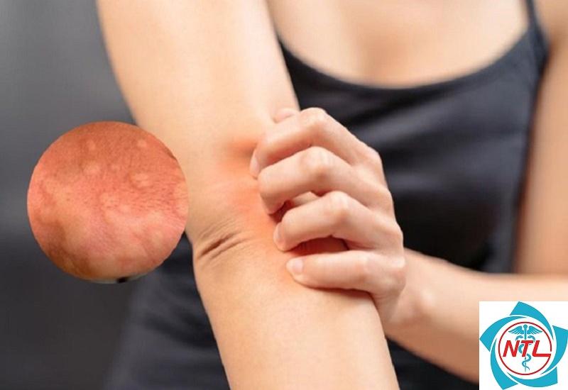 ngứa da về đêm