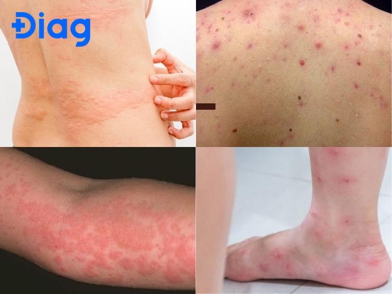 ngứa toàn thân khám nội tổng hợp - Image 2