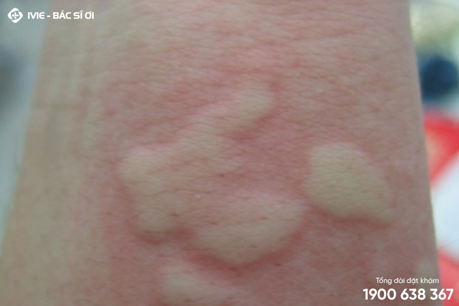 ngứa toàn thân khám nội tổng hợp - Image 3