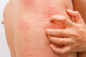 ngứa toàn thân khám nội tổng hợp