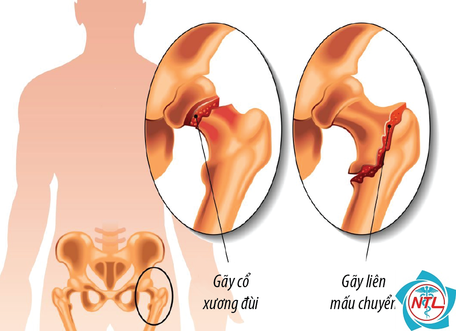 người già bị gãy xương háng