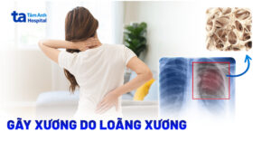 nguy cơ gãy xương ở người loãng xương