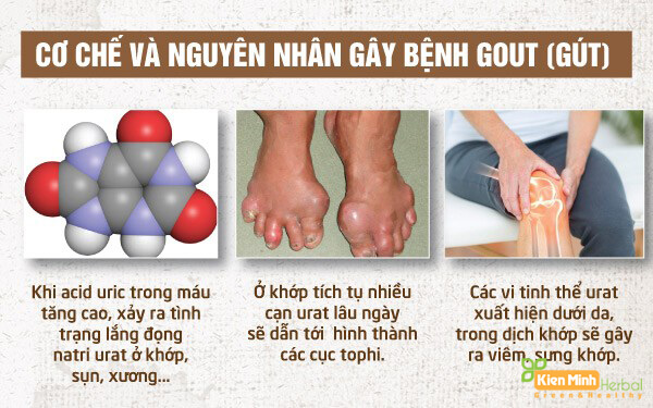 nguyên nhân bệnh gout - Image 2