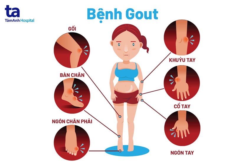 nguyên nhân bệnh gout - Image 3
