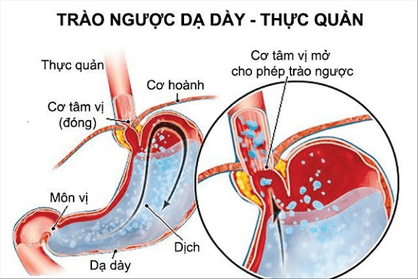 nguyên nhân buồn nôn - Image 2