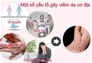 nguyên nhân của viêm da cơ địa