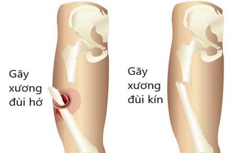 nguyên nhân dẫn đến gãy xương - Image 2