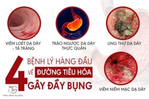 nguyên nhân đầy bụng