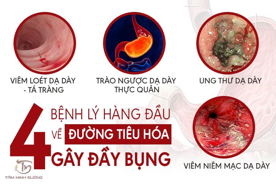 nguyên nhân đầy bụng