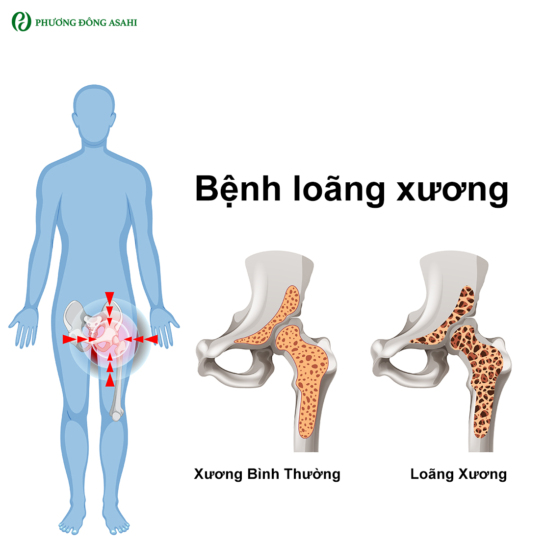 nguyên nhân loãng xương - Image 5