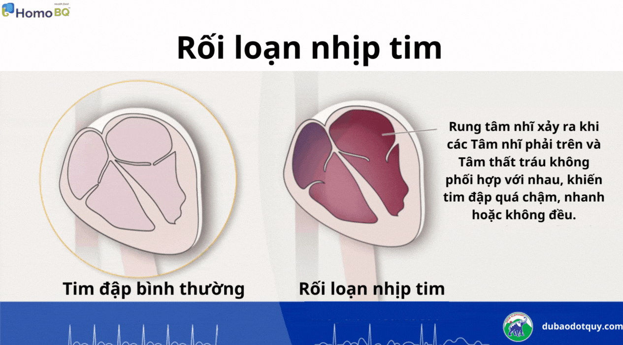 nguyên nhân rối loạn nhịp tim - Image 2