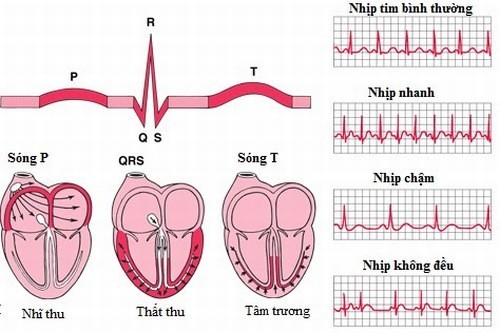 nguyên nhân rối loạn nhịp tim - Image 3
