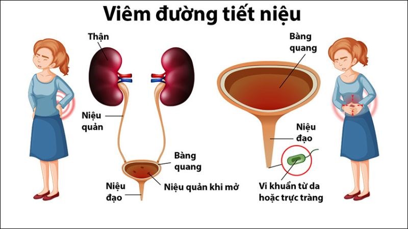 nguyên nhân tiểu buốt - Image 2