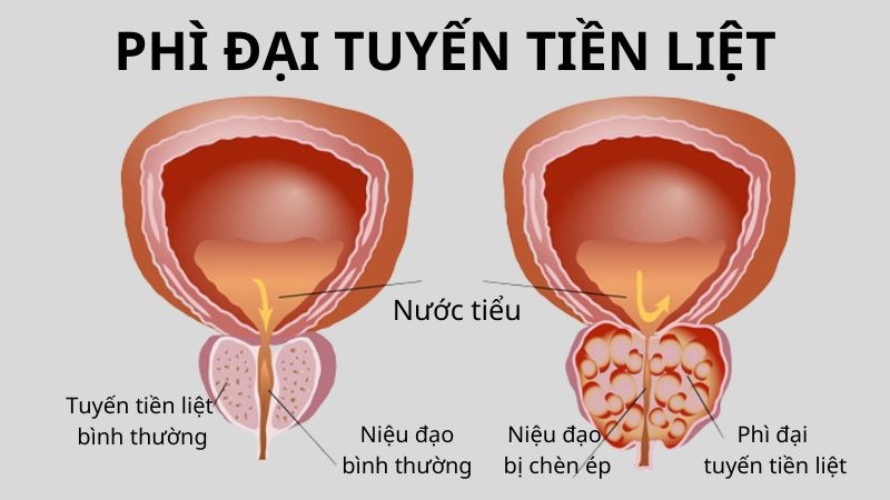 nguyên nhân tiểu buốt - Image 4