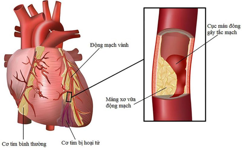 nguyên nhân tim đập nhanh - Image 3