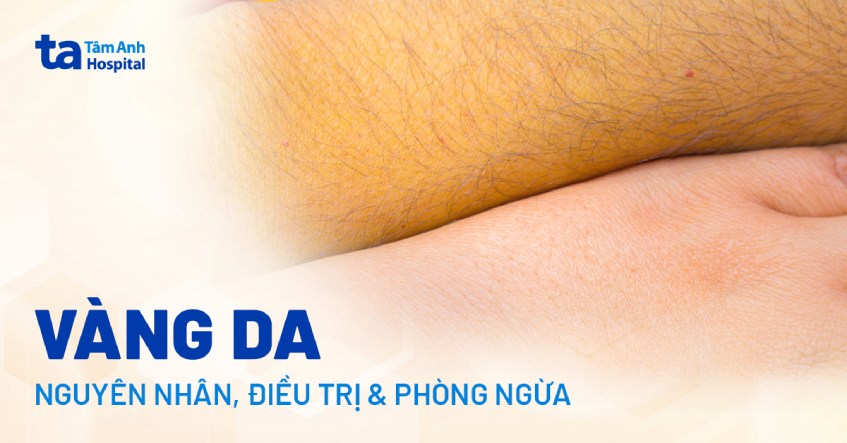 nguyên nhân vàng da - Image 3