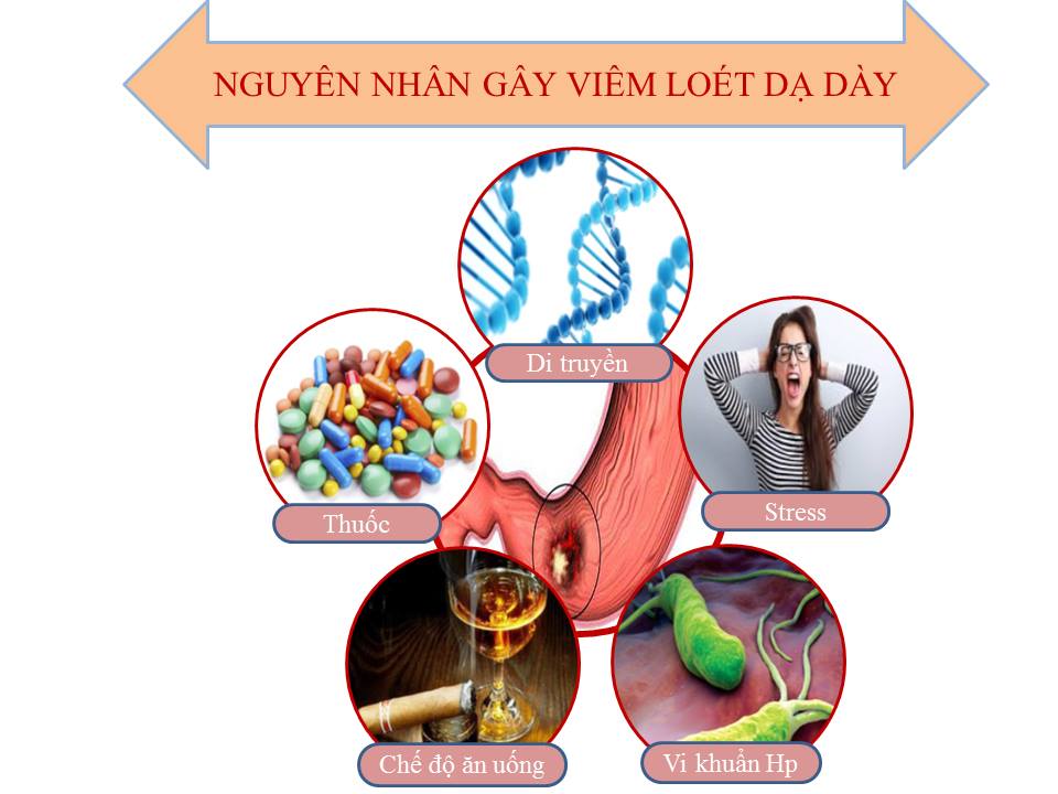 nguyên nhân viêm loét dạ dày - Image 4