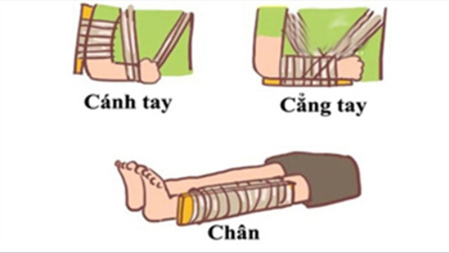 nguyên tắc bất động gãy xương - Image 2