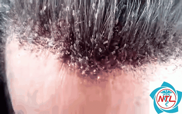 nhiễm chấy tóc - Image 2