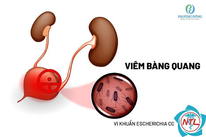 nhiễm khuẩn bàng quang - Image 5