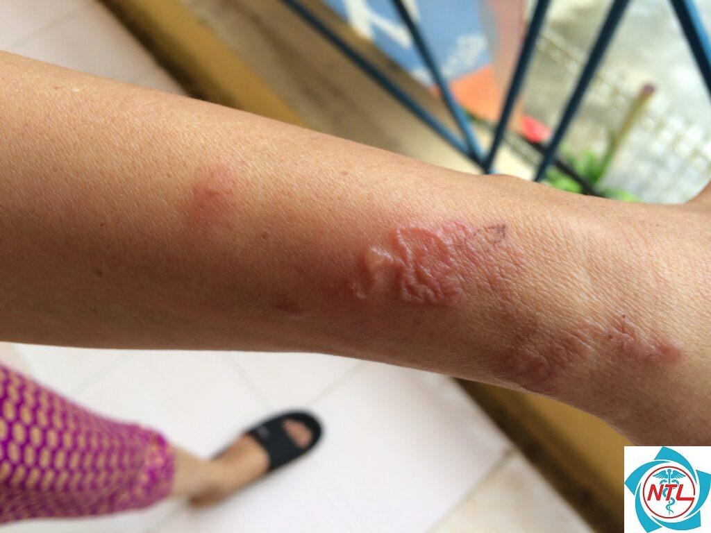 nhiễm ký sinh trùng da
