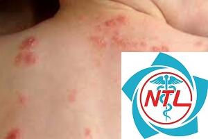 nhiễm ký sinh trùng da - Image 4
