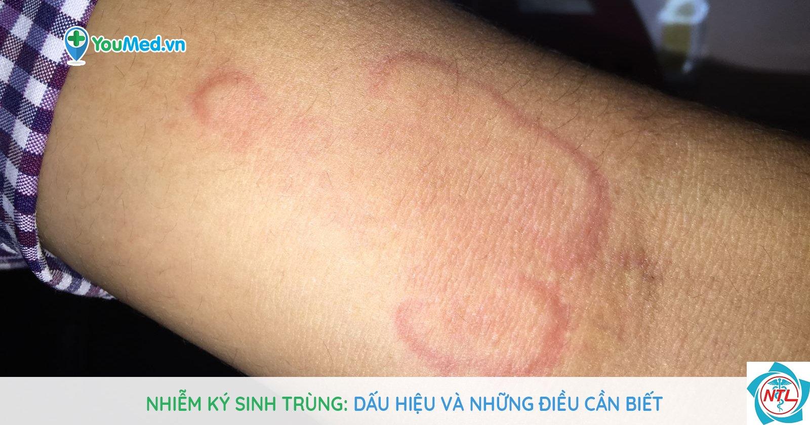 nhiễm ký sinh trùng da - Image 5