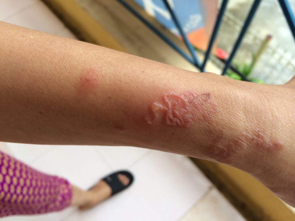 nhiễm ký sinh trùng trên da