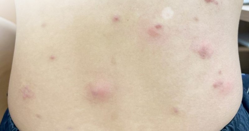 nhiễm ký sinh trùng trên da - Image 5