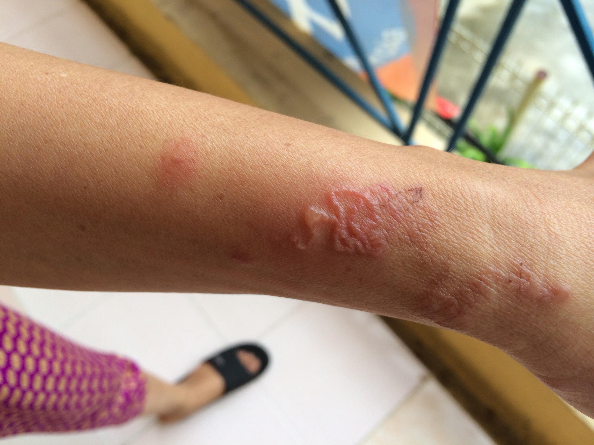 nhiễm ký sinh trùng trên da - Image 1