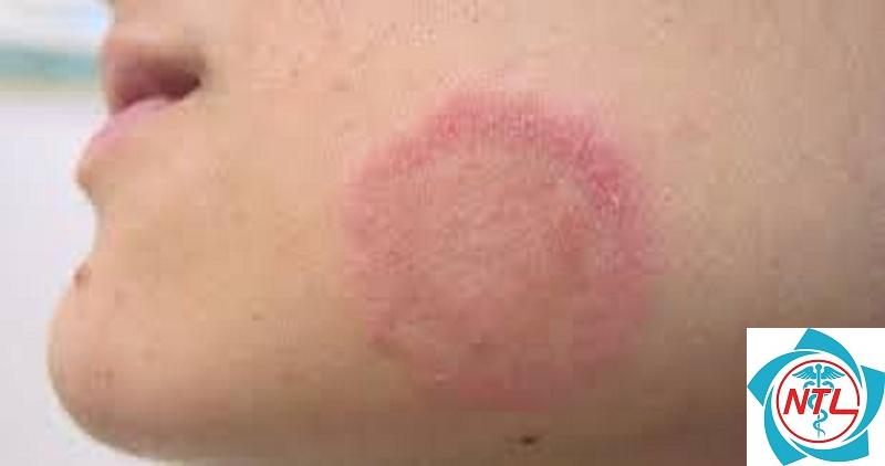 nhiễm nấm candida da - Image 2