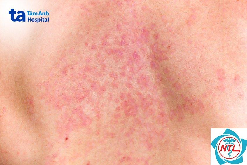 nhiễm nấm candida da - Image 4