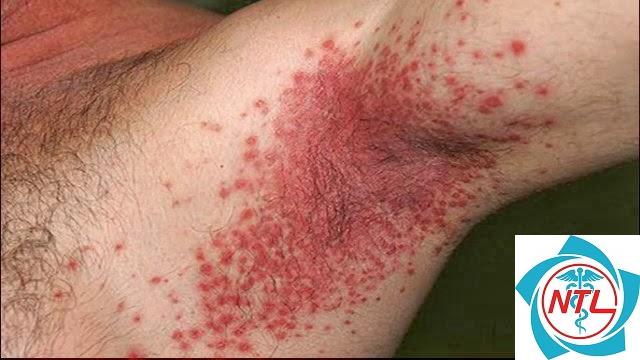nhiễm nấm candida da - Image 5