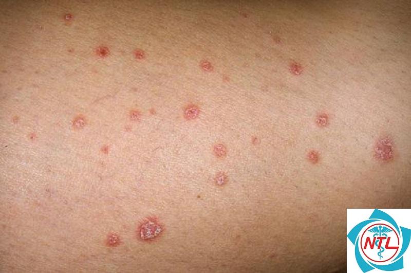 nhiễm nấm candida da