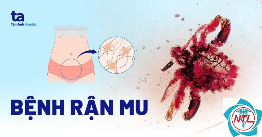 nhiễm rận mu