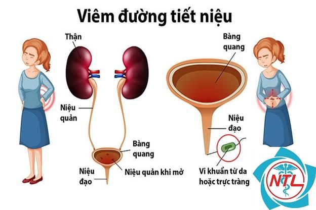 nhiễm trùng đường tiểu - Image 3