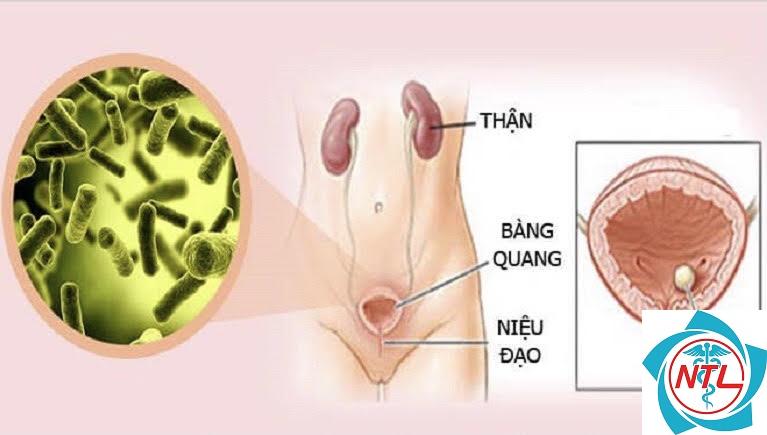 nhiễm trùng niệu đạo - Image 2