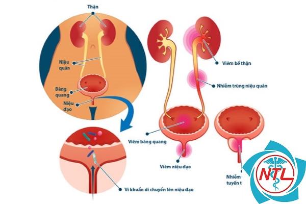 nhiễm trùng niệu đạo