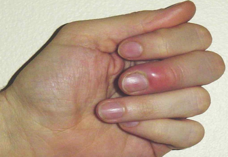 nhiễm trùng quanh móng - Image 3