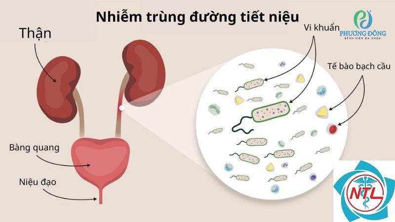 nhiễm trùng tiết niệu ở trẻ em - Image 4
