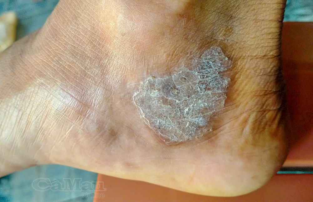 nhiễm virus trên da - Image 5