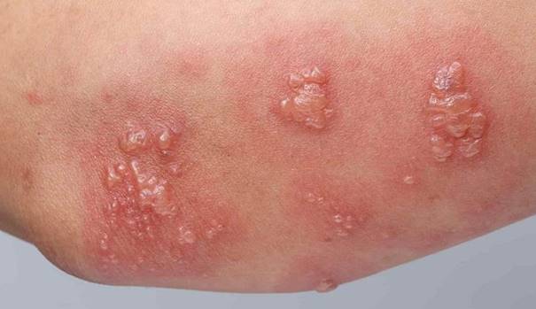 nhiễm virus trên da