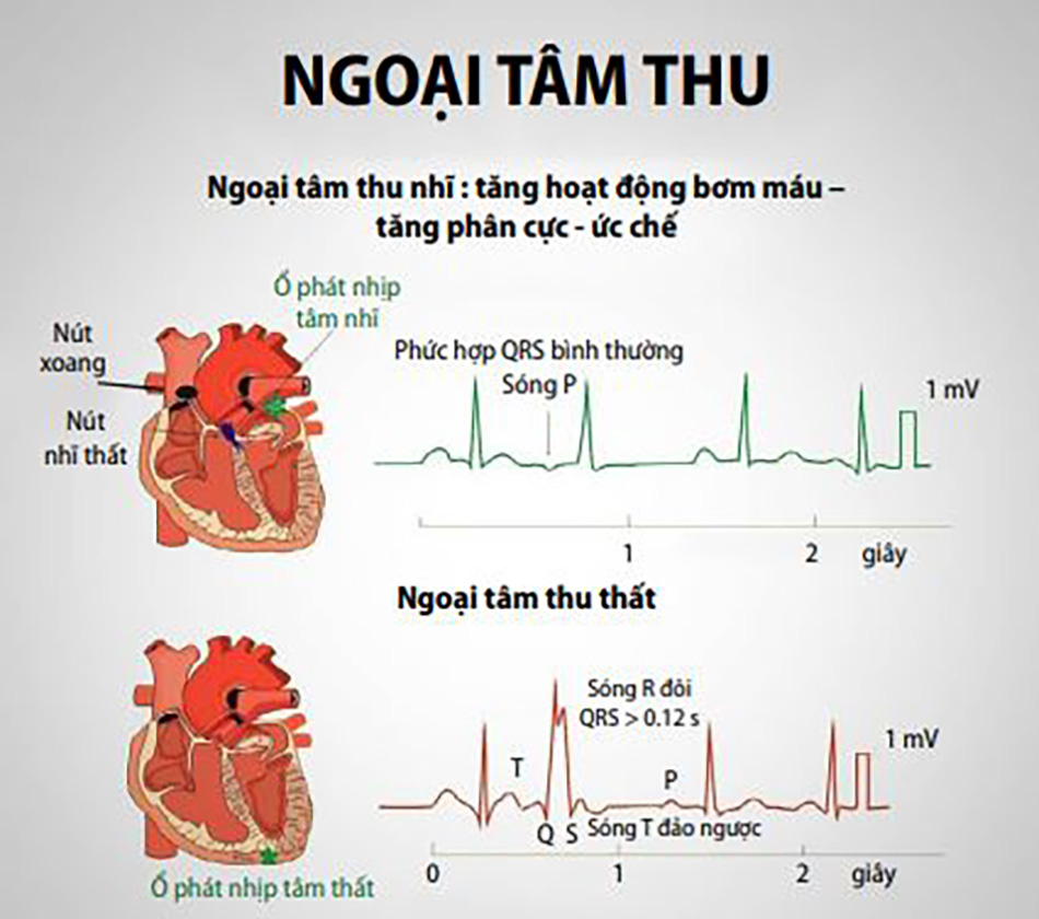 nhịp tim bất thường khi vận động - Image 4